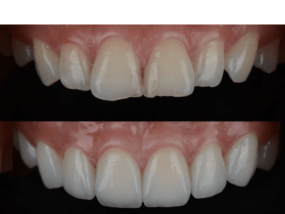 Crown & Bridge Restorations - A&B Dental Lab